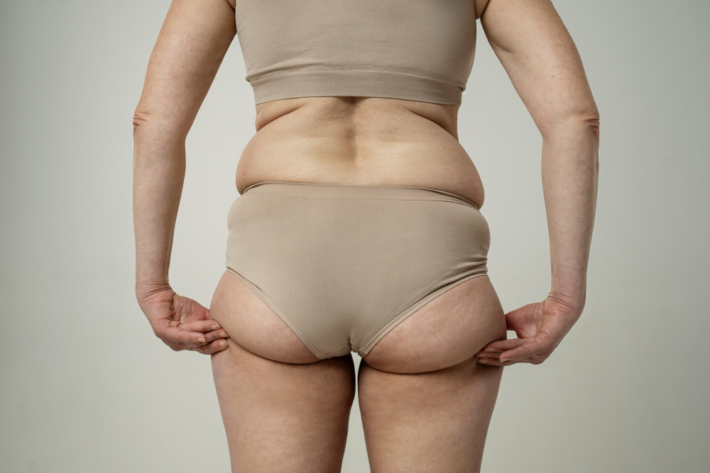 Hands-On in Lipedema Surgery